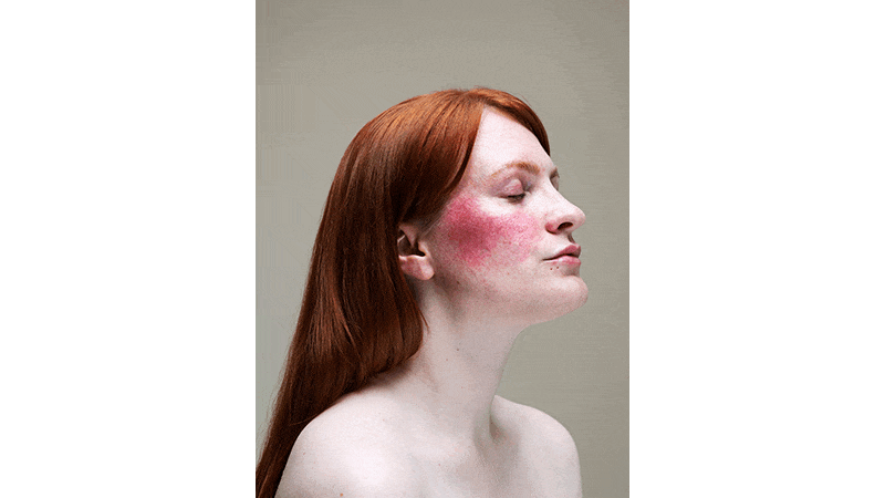Portraits of three women with skin conditions such as acne, rosacea and eczma. From the series titled Epidermis by photographer Sophie Harris-Taylor