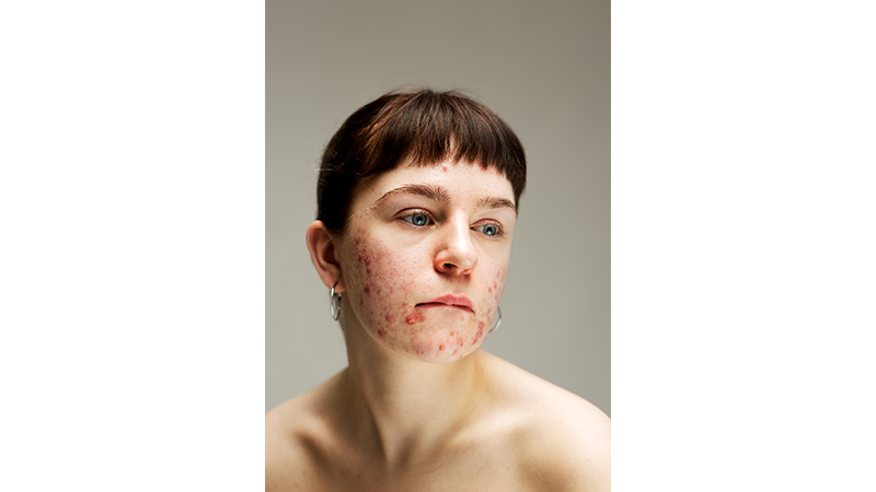 Portrait of a woman with acne and scarring. From the series titled Epidermis by photographer Sophie Harris-Taylor